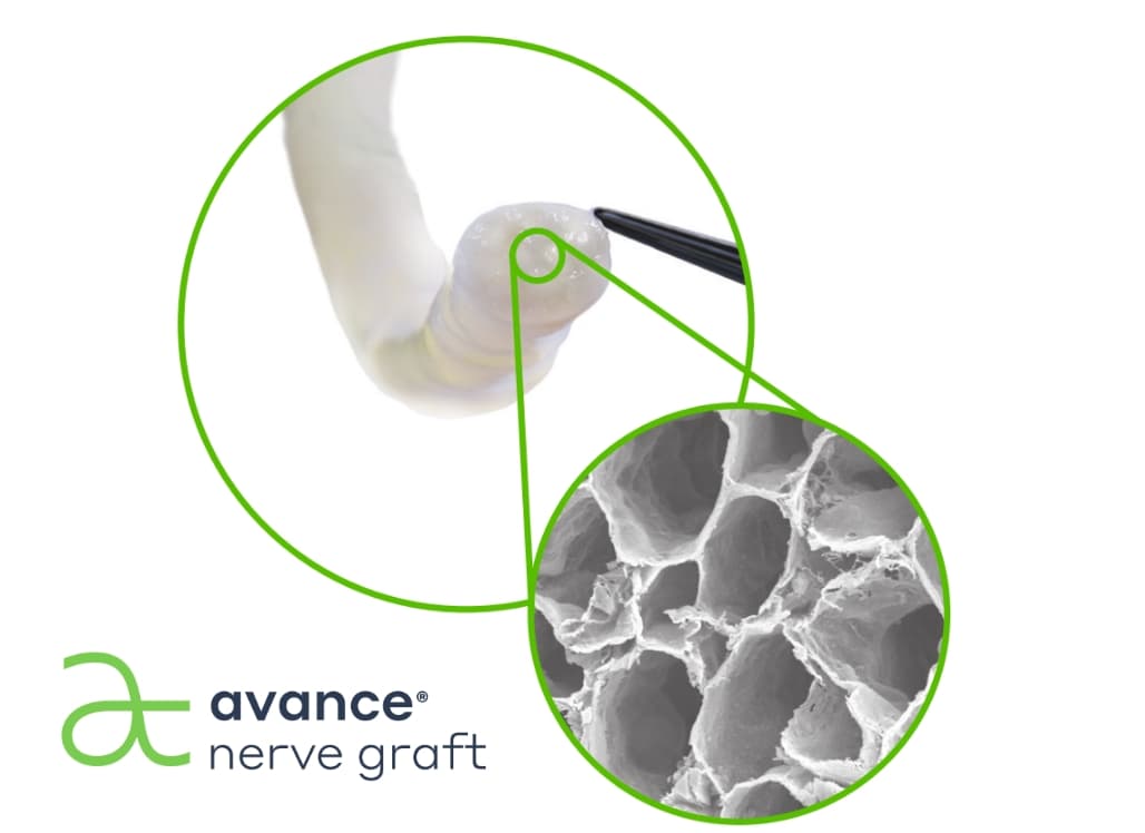 FDA Clears Avance Nerve Graft, Potential Twelve Year Exclusivity