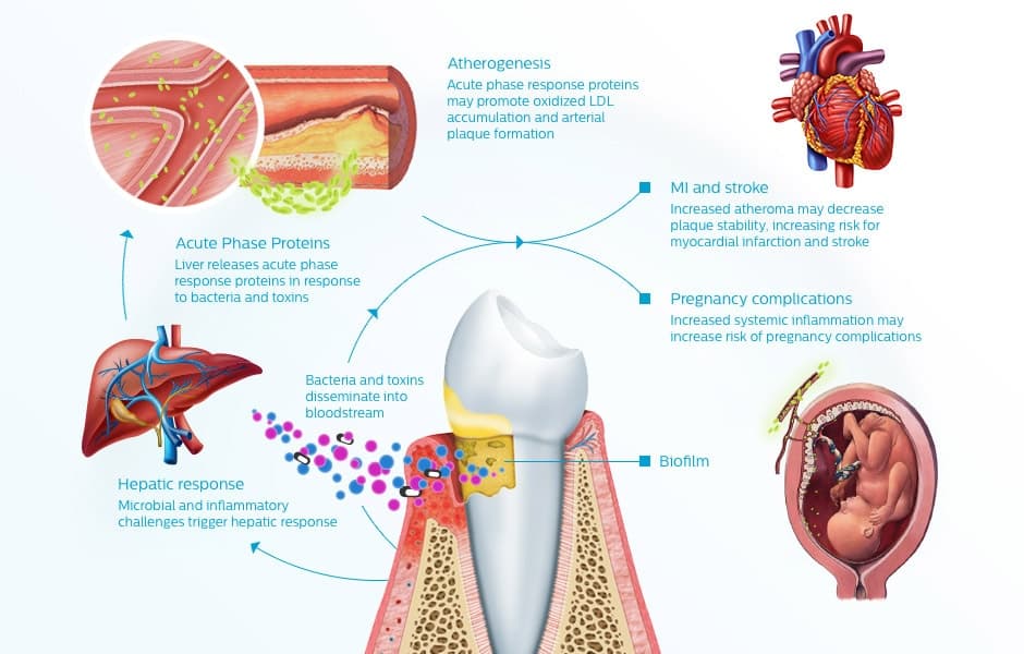 Oral Health Problems Tied to Elevated Stroke Risk, New Study Finds